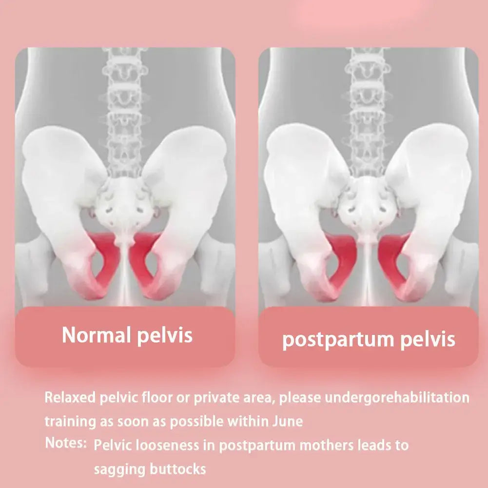 Illustration comparing normal and postpartum pelvis, highlighting pelvic floor condition impacts on women's health.